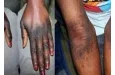 Benin : l'ABMed interdit la vente et l'utilisation de 12 produits cosmétiques de dépigmentation (liste) 