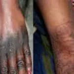 Benin : l'ABMed interdit la vente et l'utilisation de 12 produits cosmétiques de dépigmentation (liste) 