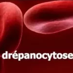 Drépanocytose : voici le remède magique pour soulager les personnes atteintes de cette maladie