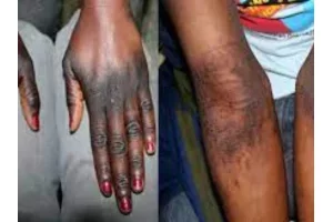 Benin : l'ABMed interdit la vente et l'utilisation de 12 produits cosmétiques de dépigmentation (liste) 