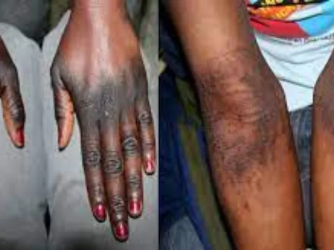 Benin : l'ABMed interdit la vente et l'utilisation de 12 produits cosmétiques de dépigmentation (liste) 